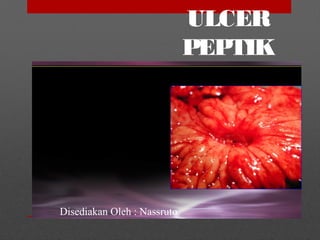 ULCER
PEPTIK
Disediakan Oleh : Nassruto
 