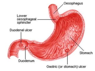 Ulcer ppt