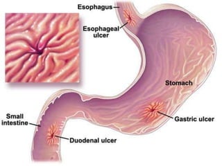 Ulcer ppt
