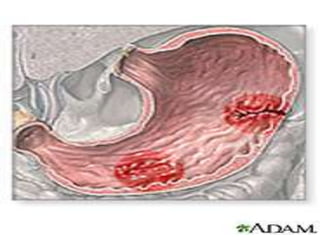 Ulcer ppt