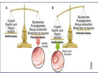 Ulcer ppt
