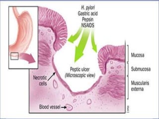 Ulcer ppt