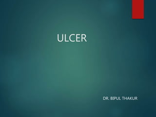 ULCER
DR. BIPUL THAKUR
 