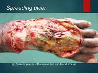 Spreading ulcer
 Edge : Inflammed, irregular and oedematous
Acute painful ulcer
 Floor: No healthy granulation tissue
profuse purulent discharge and slough +
surrounding area red & oedematous
 Regional LN s: Enlarged & tender
Fig: Spreading ulcer with copious and purulent discharge
 