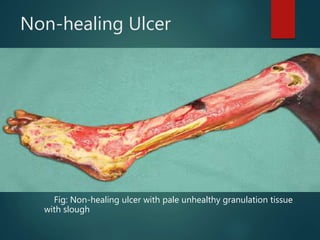 Non-healing Ulcer
 Floor : Unhealthy granulation tissue and slough
Serosanguinous/purulent/bloody
discharge
 Regional LNs: may be enlarged but non-tender
Fig: Non-healing ulcer with pale unhealthy granulation tissue
with slough
 