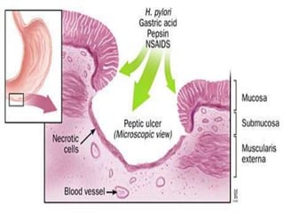 Ulcerease Chemical Equation Ulcers | PPTX