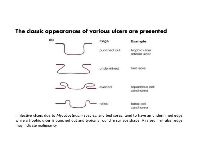 Ulcer - Wikipedia