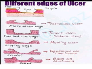 ULCERS, classification, presentation.ppt