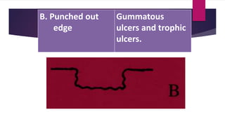 B. Punched out
edge
Gummatous
ulcers and trophic
ulcers.
 