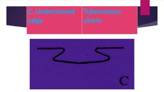 C. Undermined
edge
Tuberculous
ulcers
 
