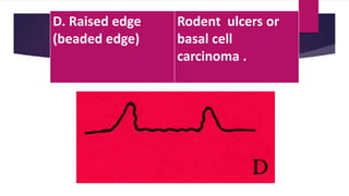 D. Raised edge
(beaded edge)
Rodent ulcers or
basal cell
carcinoma .
 