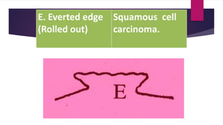 E. Everted edge
(Rolled out)
Squamous cell
carcinoma.
 