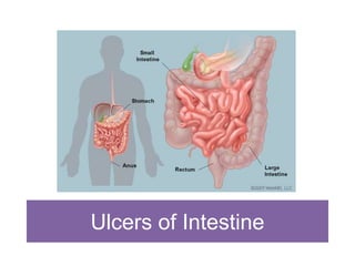 Ulcers of Intestine
 