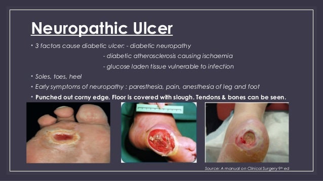 foot ulcers pictures
