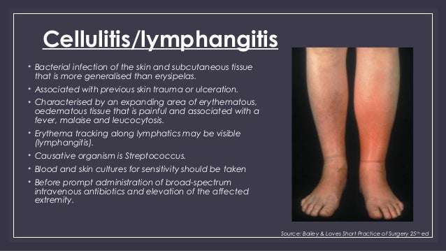 Erysipelas Symptoms, Diagnosis, Treatments and Causes ...