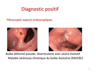 Diagnostic positif
Fibroscopie aspects endoscopiques
Bulbe déformé pseudo- diverticulaire avec ulcère évolutif
Maladie ulcéreuse chronique du bulbe évolutive (MUCBE)
11
 
