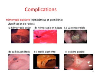Complications
Hémorragie digestive (hématémèse et ou méléna)
Classification de Forrest
Ia hémorragie en jet IIb hémorragie en nappe IIa vaisseau visible
IIb caillot adhérent IIc tache pigmenté III cratère propre
17
 