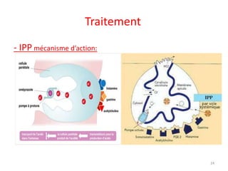 Traitement
- IPP mécanisme d’action:
24
 