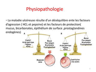 Physiopathologie
- La maladie ulcéreuse résulte d’un déséquilibre ente les facteurs
d’agression ( HCL et pepsine) et les facteurs de protection(
mucus, bicarbonates, épithélium de surface ,prostaglandines
endogènes)
3
 