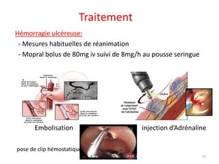 Traitement
Hémorragie ulcéreuse:
- Mesures habituelles de réanimation
- Mopral bolus de 80mg iv suivi de 8mg/h au pousse seringue
Embolisation injection d’Adrénaline
pose de clip hémostatique
31
 