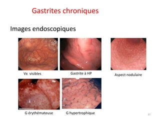 Gastrites chroniques
Images endoscopiques
Vx visibles Gastrite à HP Aspect nodulaire
G érythémateuse G hypertrophique 37
 