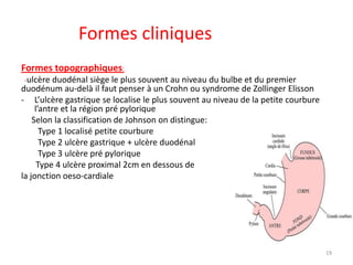 Ulcأ¨res gastro duodأ©naux