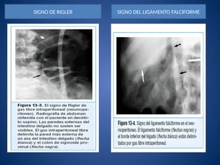 ULCUS PEPTICO PERFORADO 2021.pptx para el aprendizaje | PPTX