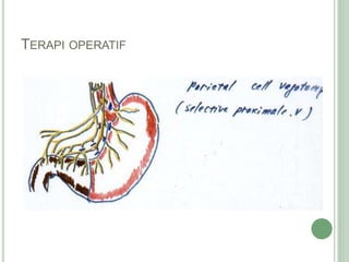 TERAPI OPERATIF
 