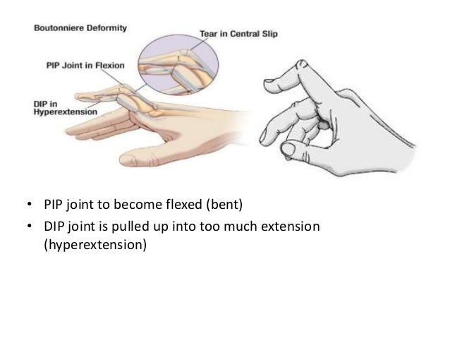 Ulnar deviations