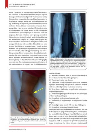 Ulnar dimelia – a rare and neglected anomaly of upper extremity | PDF