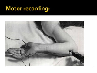 Ulnar nerve antomy and recording techniques