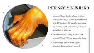Comprehensive Overview of Ulnar Nerve Anatomy and Injury Management | PPTX