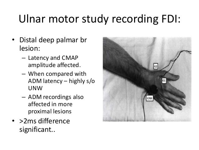ulnar neuropathy at wrist electrophysiological approache radiculopathy vs neuropathy