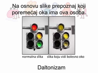 Na osnovu slike prepoznaj koji
poremećaj oka ima ova osoba.
normalna slika slika koju vidi bolesno oko
Daltonizam
 