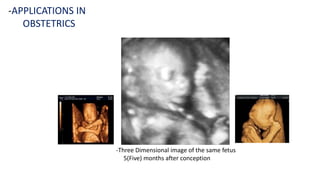 -Three Dimensional image of the same fetus
5(Five) months after conception
-APPLICATIONS IN
OBSTETRICS
 