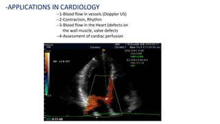 --1-Blood flow in vessels (Doppler US)
--2-Contraction, Rhythm
--3-Blood flow in the Heart (defects on
the wall muscle, valve defects
--4-Assessment of cardiac perfusion
-APPLICATIONS IN CARDIOLOGY
 