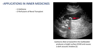 --1-Gallstone
--2-Perfusionn of Renal Transplant
-APPLICATIONS IN INNER MEDICINES
-Gallstone (Red arrow)within the Gallbladder
produces a bright surface ECHO and causes
a dark acoustic shadow (S)
 