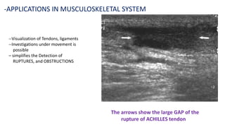 --Visualization of Tendons, ligaments
--Investigations under movement is
possible
– simplifies the Detection of
RUPTURES, and OBSTRUCTIONS
-APPLICATIONS IN MUSCULOSKELETAL SYSTEM
The arrows show the large GAP of the
rupture of ACHILLES tendon
 