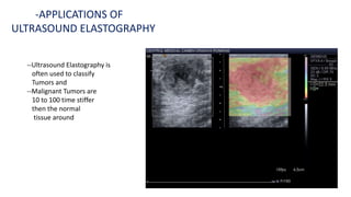 --Ultrasound Elastography is
often used to classify
Tumors and
--Malignant Tumors are
10 to 100 time stiffer
then the normal
tissue around
-APPLICATIONS OF
ULTRASOUND ELASTOGRAPHY
 