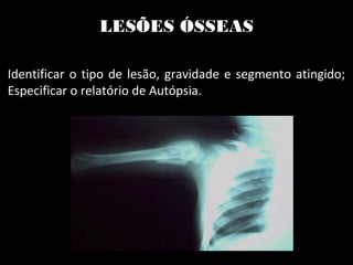 LESÕES ÓSSEAS
Identificar o tipo de lesão, gravidade e segmento atingido;
Especificar o relatório de Autópsia.
 