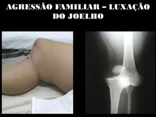 AGRESSÃO FAMILIAR – LUXAÇÃO
DO JOELHO
 