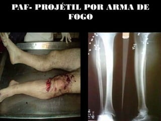 PAF- PROJÉTIL POR ARMA DE
FOGO
 