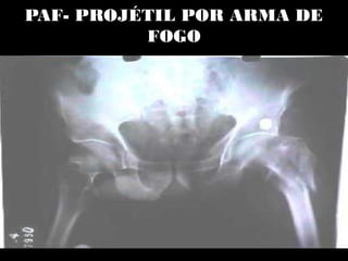 PAF- PROJÉTIL POR ARMA DE
FOGO
 