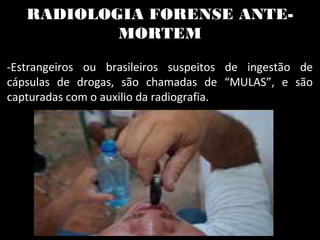 RADIOLOGIA FORENSE ANTE-
MORTEM
-Estrangeiros ou brasileiros suspeitos de ingestão de
cápsulas de drogas, são chamadas de “MULAS”, e são
capturadas com o auxilio da radiografia.
 