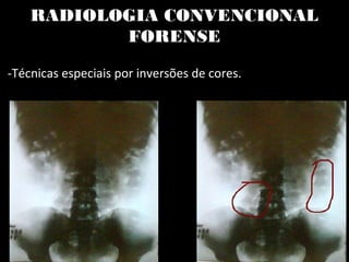 RADIOLOGIA CONVENCIONAL
FORENSE
-Técnicas especiais por inversões de cores.
 