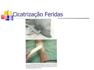 Cicatrização Feridas 