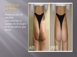 A DEMAS
AYUDA
Disminución de
celulitis
convirtiendo el
cuerpo de la mujer
en la escultura que
desea
 