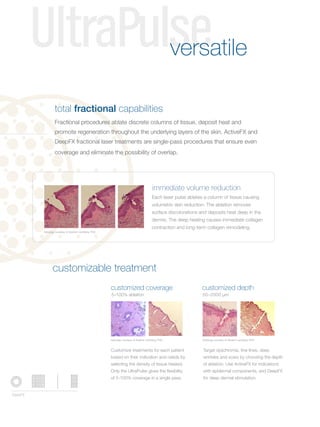 UltraPulse                                                                                  versatile

                 total fractional capabilities
                 Fractional procedures ablate discrete columns of tissue, deposit heat and
                 promote regeneration throughout the underlying layers of the skin. ActiveFX and
                 DeepFX fractional laser treatments are single-pass procedures that ensure even
                 coverage and eliminate the possibility of overlap.




                                                                                         immediate volume reduction
                                                                                         Each laser pulse ablates a column of tissue causing
                                                                                         volumetric skin reduction. The ablation removes
                                                                                         surface discolorations and deposits heat deep in the
                                                                                         dermis. The deep heating causes immediate collagen
                                                                                         contraction and long-term collagen remodeling.
         histology courtesy of Vladimir Lemberg, PhD




                customizable treatment
                                                       customized coverage                                       customized depth
                                                       5–100% ablation                                           50 –2000 µm




                                                       histology courtesy of Vladimir Lemberg, PhD               histology courtesy of Vladimir Lemberg, PhD


                                                       Customize treatments for each patient                     Target dyschromia, fine lines, deep
                                                       based on their indication and needs by                    wrinkles and scars by choosing the depth
                                                       selecting the density of tissue treated.                  of ablation. Use ActiveFX for indications
                                                       Only the UltraPulse gives the flexibility                 with epidermal components, and DeepFX
                                                       of 5-100% coverage in a single pass.                      for deep dermal stimulation.


DeepFX
 