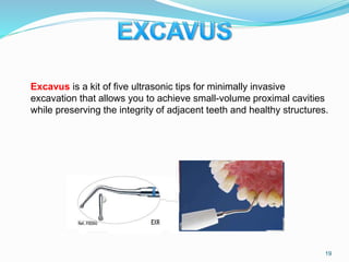 Excavus is a kit of five ultrasonic tips for minimally invasive
excavation that allows you to achieve small-volume proximal cavities
while preserving the integrity of adjacent teeth and healthy structures.
19
 