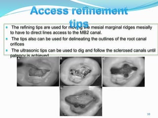 The refining tips are used for moving the mesial marginal ridges mesially
to have to direct lines access to the MB2 canal.
 The tips also can be used for delineating the outlines of the root canal
orifices
 The ultrasonic tips can be used to dig and follow the sclerosed canals until
patency is achieved.
33
 